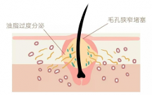 青春期臉上長(zhǎng)白色的小痘痘怎么辦？米迪豆專(zhuān)業(yè)祛痘值得信賴(lài)！