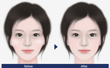 聯(lián)合麗格第 一醫(yī)院何照華院長：顴骨內(nèi)推手術(shù)后，鈦釘用不用取出？