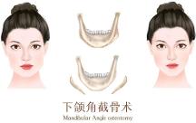 聯(lián)合麗格第 一醫(yī)院何照華院長：想做下頜角手術(shù)，該選哪種術(shù)式？